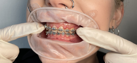 Header of braces.fetish